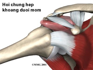 Hội chứng chèn ép khoang dưới mỏm cùng vai
